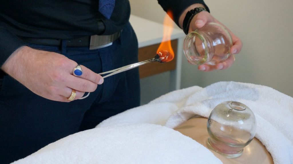 Cupping Therapy: Discover Healing Benefits in Melbourne