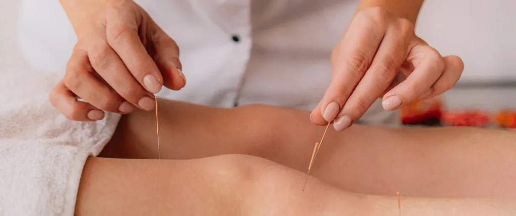 Acupuncture for Stress and Anxiety Relief: Your Essential Guide