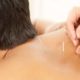 Acupuncture and Cupping: Boost Your Sports Recovery