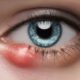 Home Remedies and Causes for Eye Styes Explained